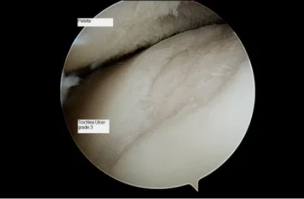 view astroscope at the joint of the knee osteoarthritis of the 3rd grade