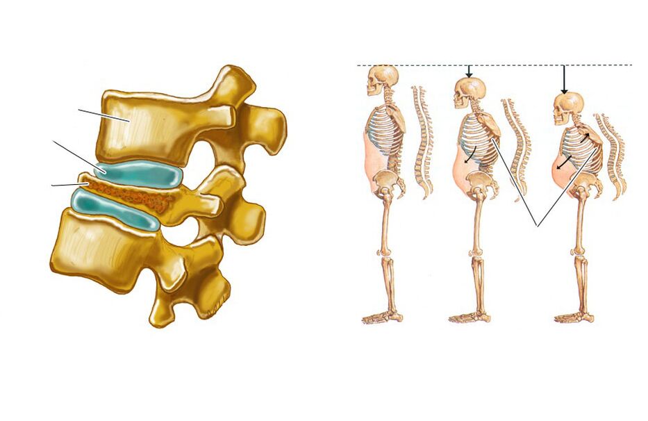 a slack spine leads to back pain