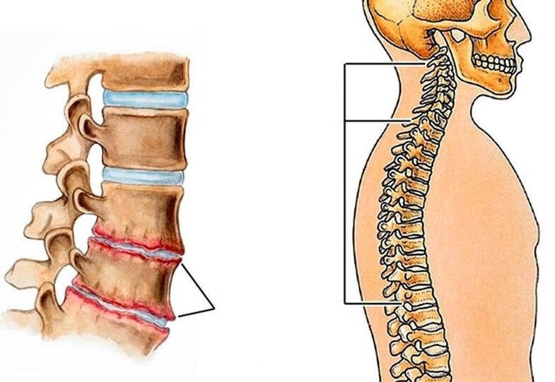 curvature of the spine leads to back pain