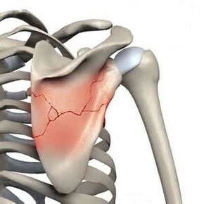 Scapular fractures are one of the leading causes of severe pain