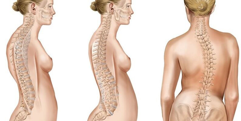 Scoliosis of the thoracic spine gives rise to the appearance of pain in the shoulder blades