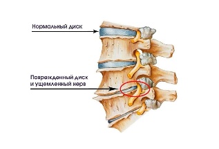 The symptoms of degenerative cervical disc disease