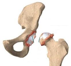 causes of hip joint arthrosis