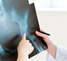 how to treat hip joint arthrosis