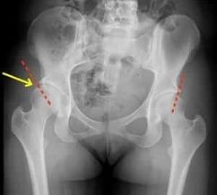 methods of treating arthrosis of the hip joint