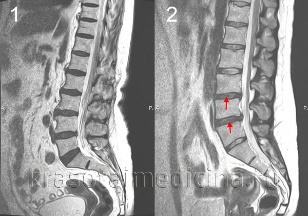 osteocondrose of the vertebral column