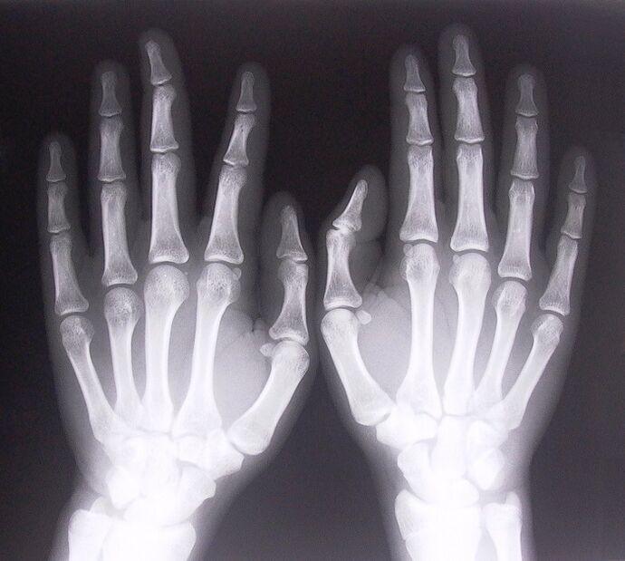 X-rays as a method for diagnosing pain in the finger joints