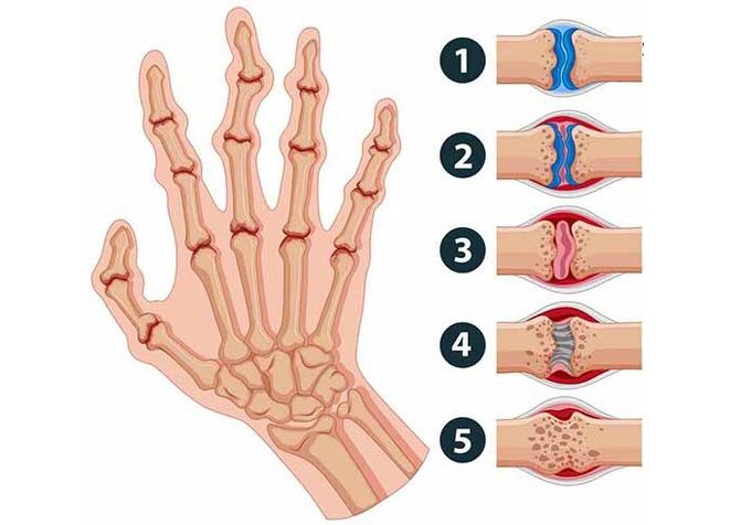 stage of development of arthritis of the finger joints